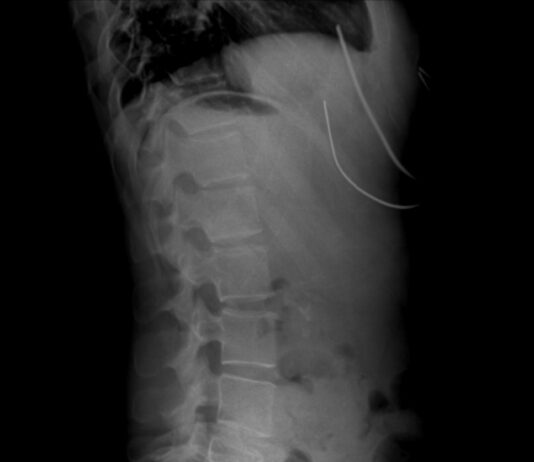 “손이 자꾸 저려요”… 거북목보다 위험한 ‘흉곽출구증후군’ A black and white photo of a man's back